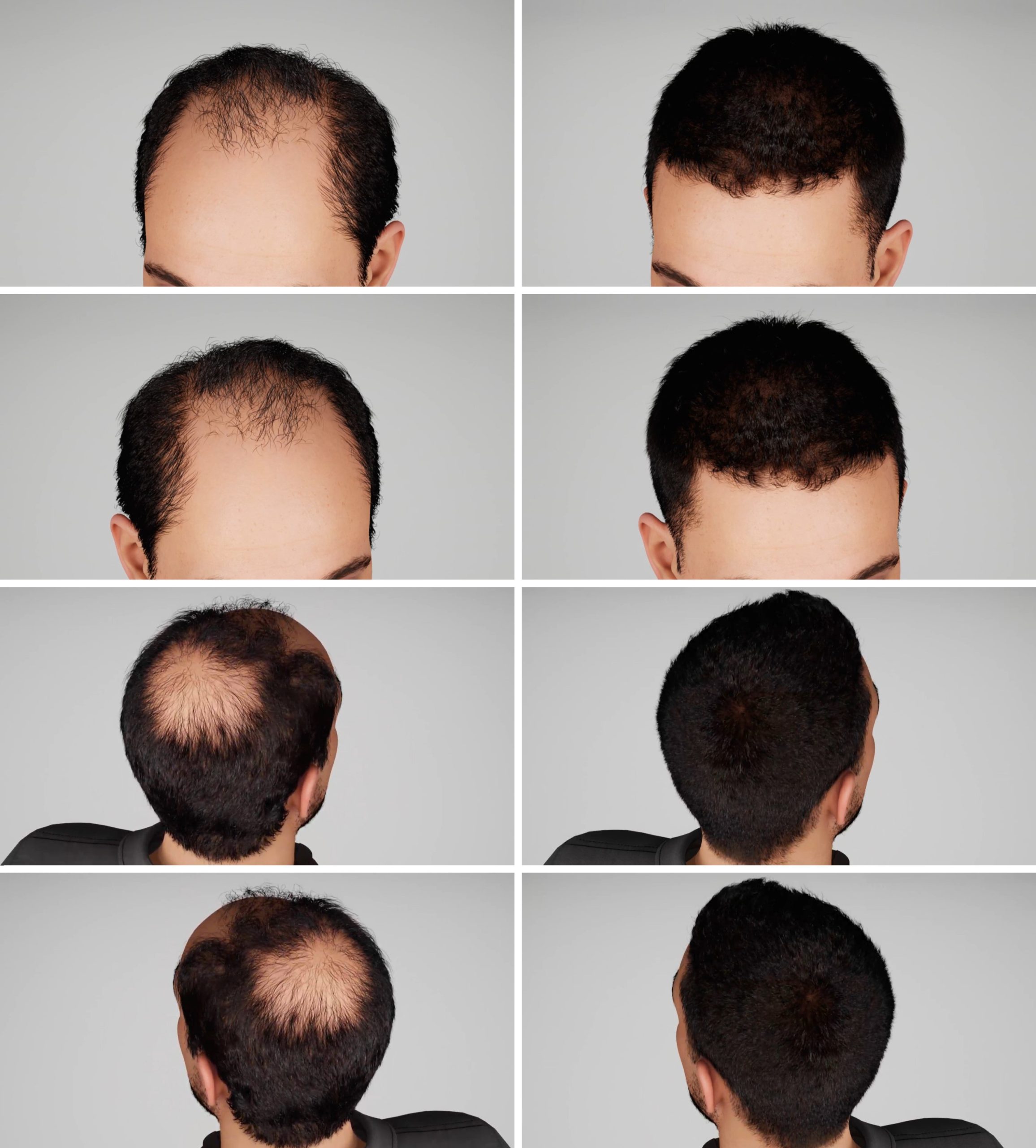 Finasteride and Minoxidil for Hair Regrowth