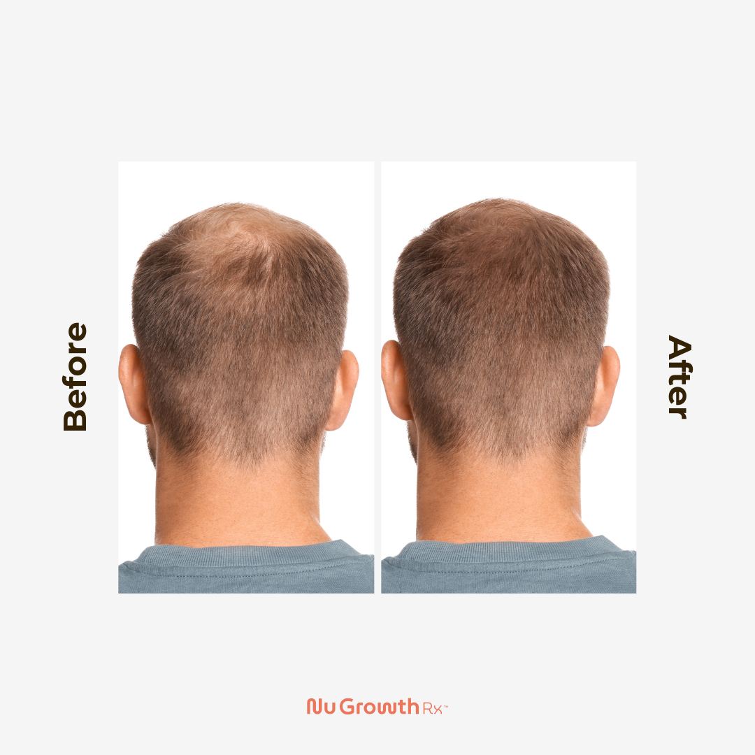 Before After - tom